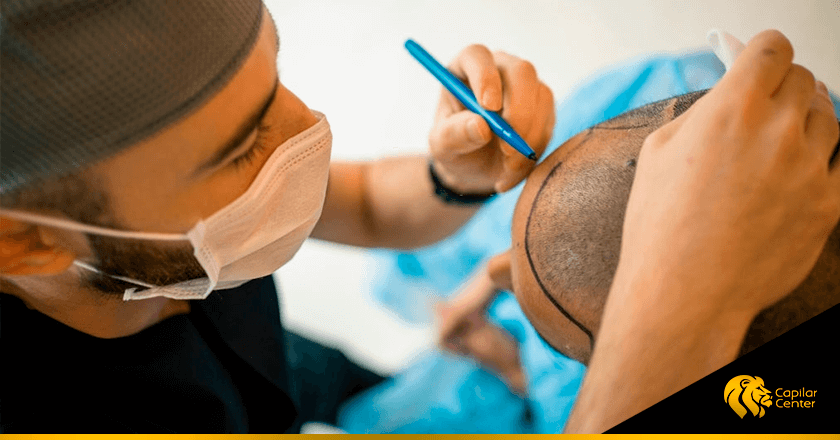 Cómo elegir un especialista en implante capilar en Perú