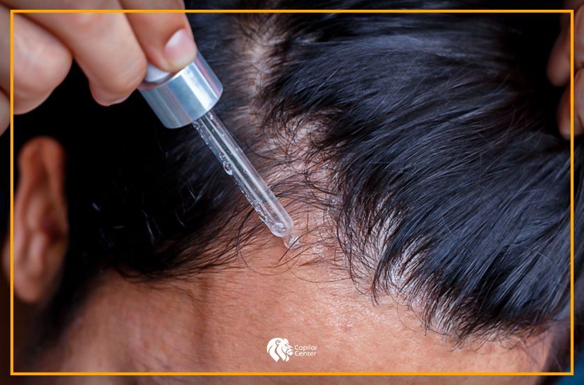 ¿Qué efectos otorga el Minoxidil en la caída del cabello?