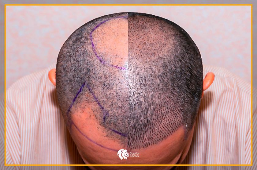 ¿El implante de cabello da resultados permanentes?