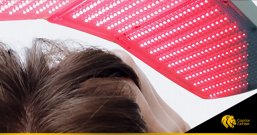 Fototerapia Capilar: tratamiento regenerativo para el cabello