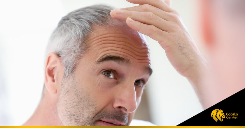 Pérdida de cabello: una de las consecuencias de la diabetes en los hombres