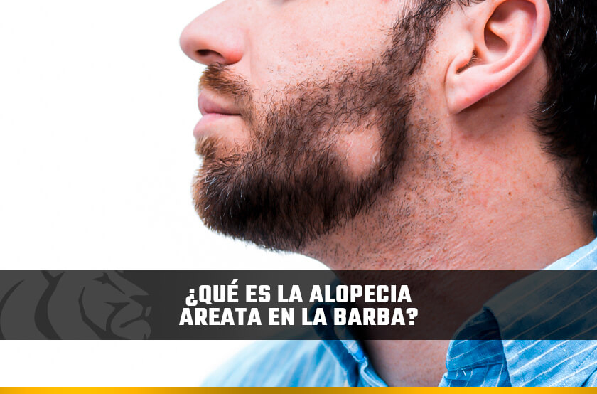 ¿Qué es la alopecia areata en la barba?