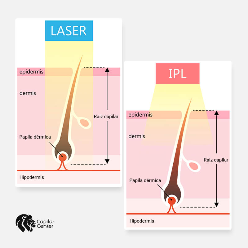 Luz Pulsada Intensa Diferencia Entre Depilacion Soprano Y Laser