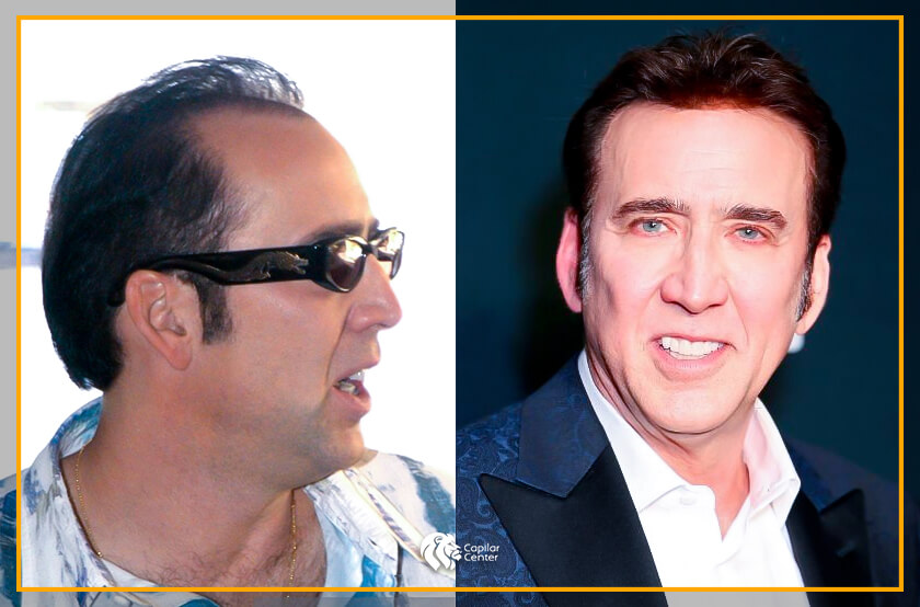 Actores que superaron la calvicie con implante capilar en Surco: Nicolas Cage