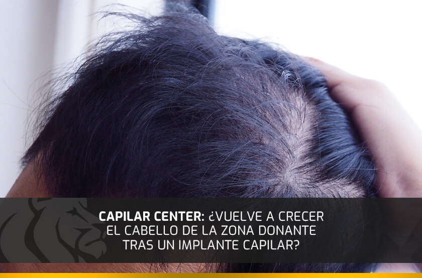 Capilar Center: ¿Vuelve a crecer el cabello de la zona donante tras un implante capilar?