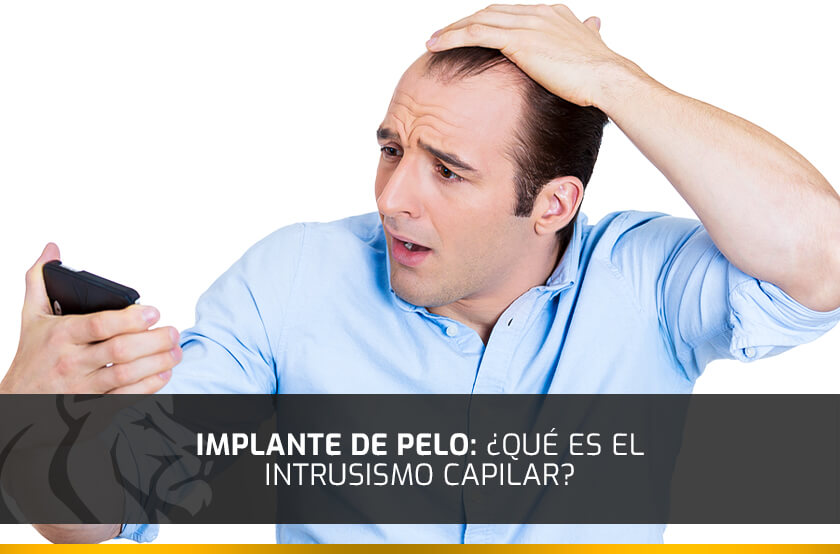 Implante de pelo: ¿Qué es el intrusismo capilar?