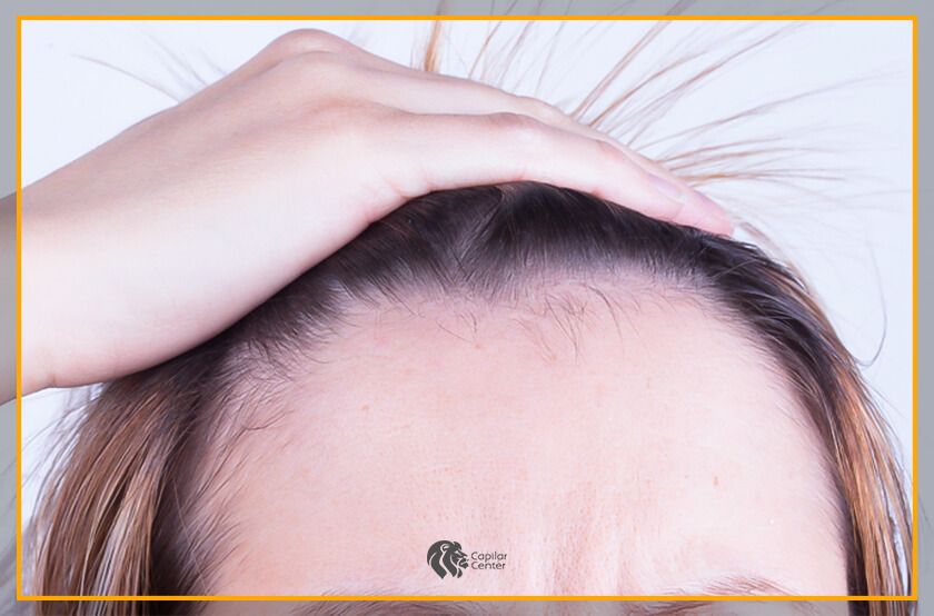 Alopecia fribosante: 
