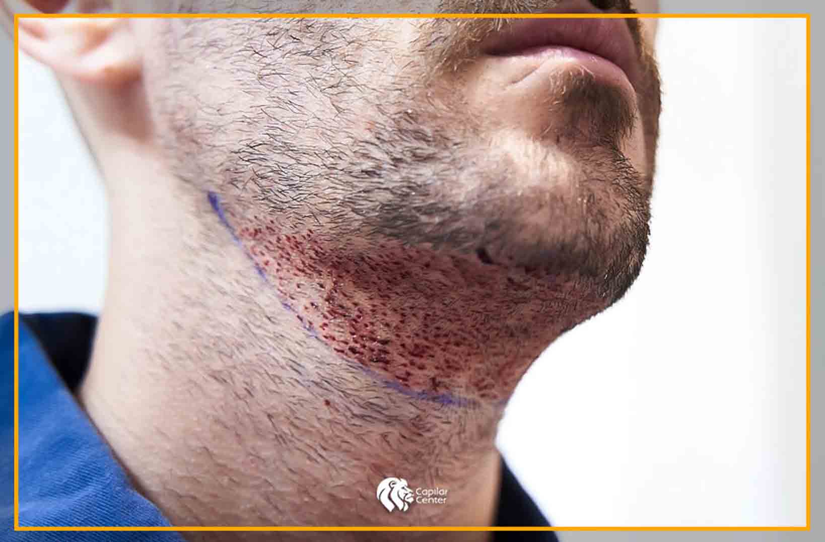 ¿El trasplante de barba es otra alternativa?