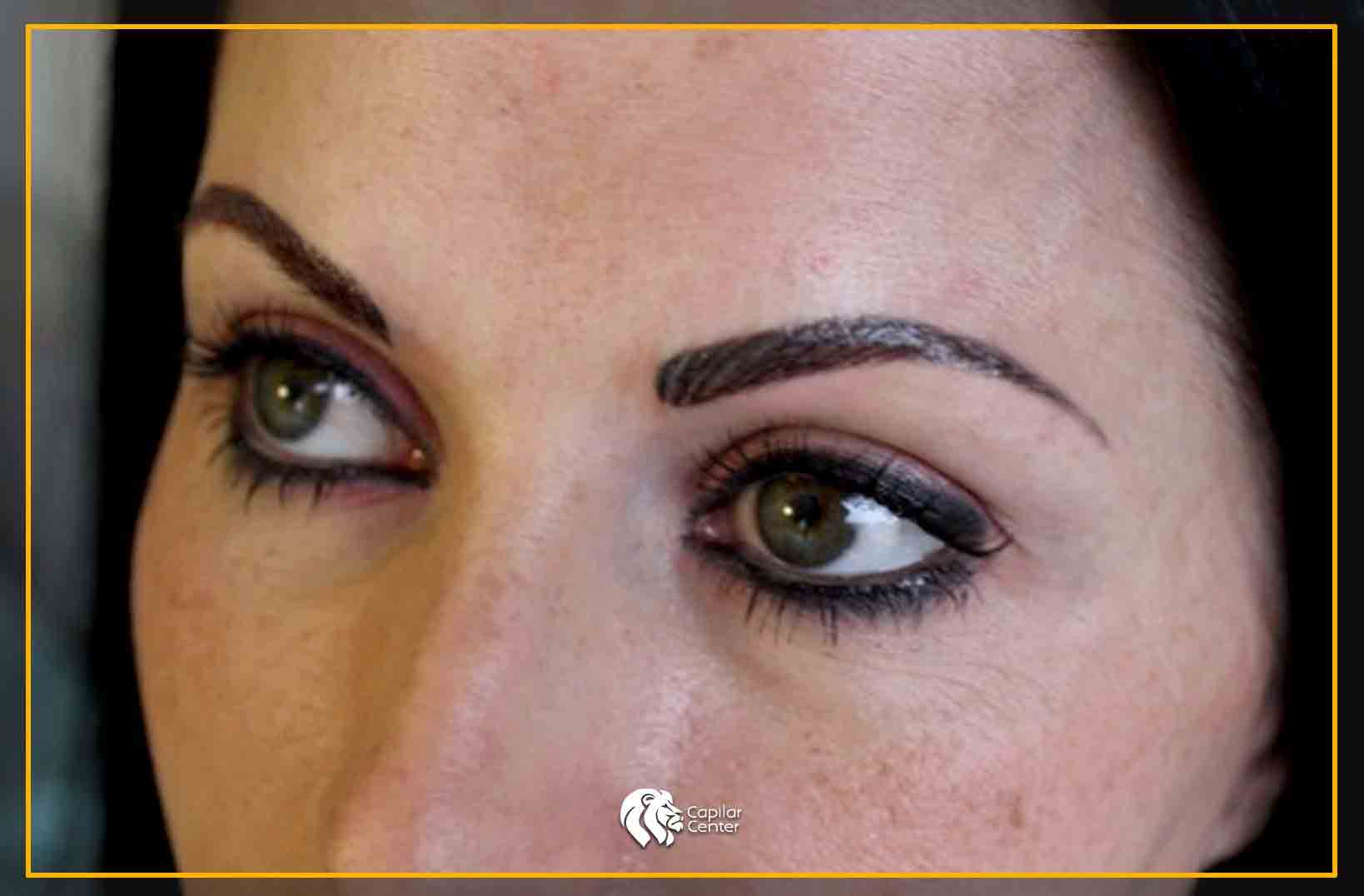 Trasplante de cejas - Consulta médica