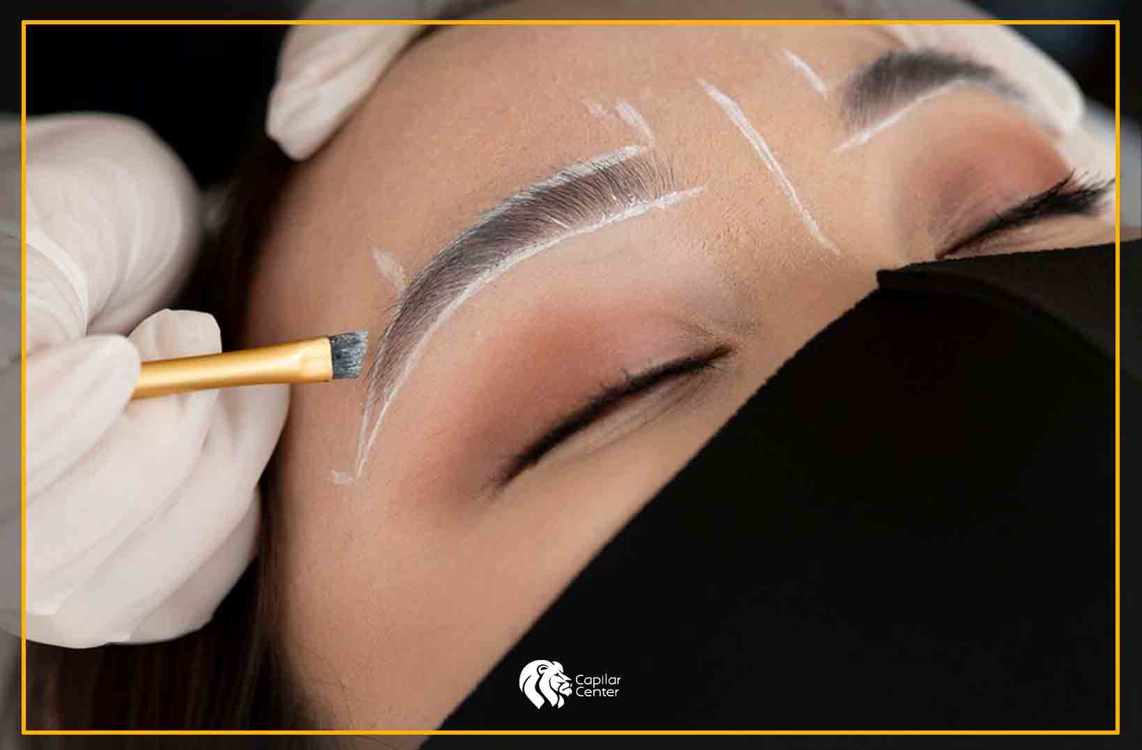 Trasplante de cejas - beneficios ¡Olvídate del maquillaje en cejas y realízate un trasplante!
