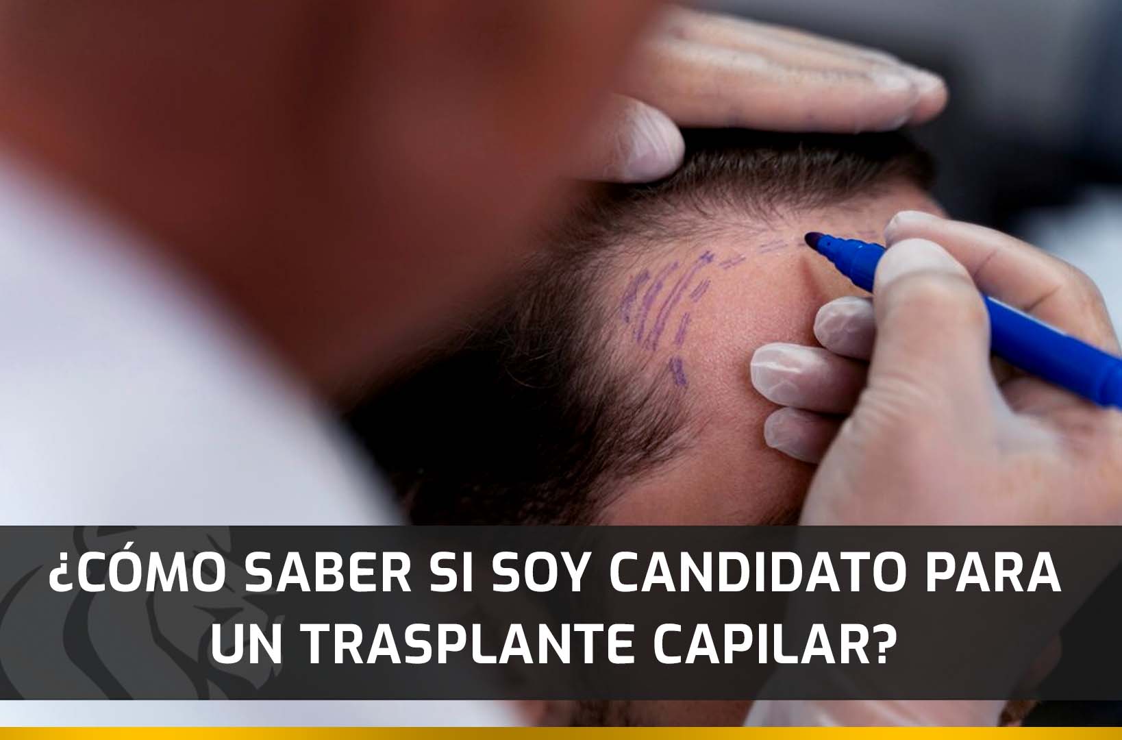 ¿Cómo saber si soy candidato para un Trasplante Capilar?