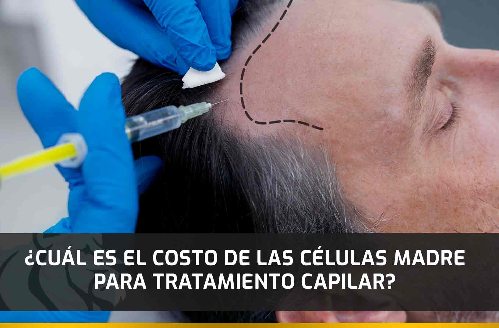 Células-Madre–tratamiento-capilar ¿Cuál es el costo de las células madre para tratamiento capilar?