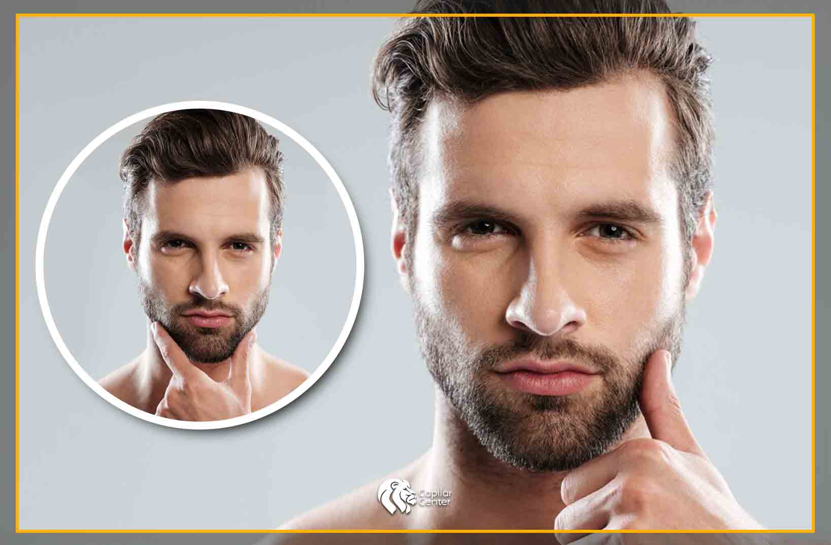 Trasplante de barba - Beneficios