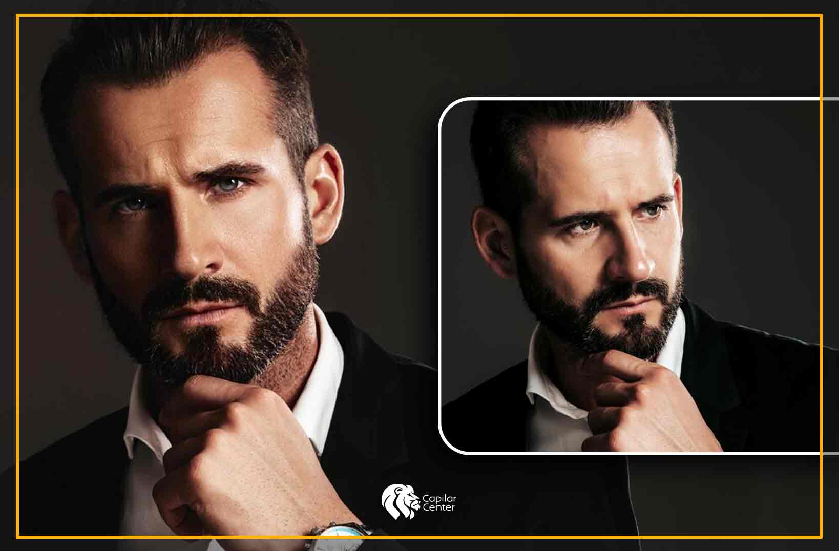 Trasplante de barba - Cirugía plástica
