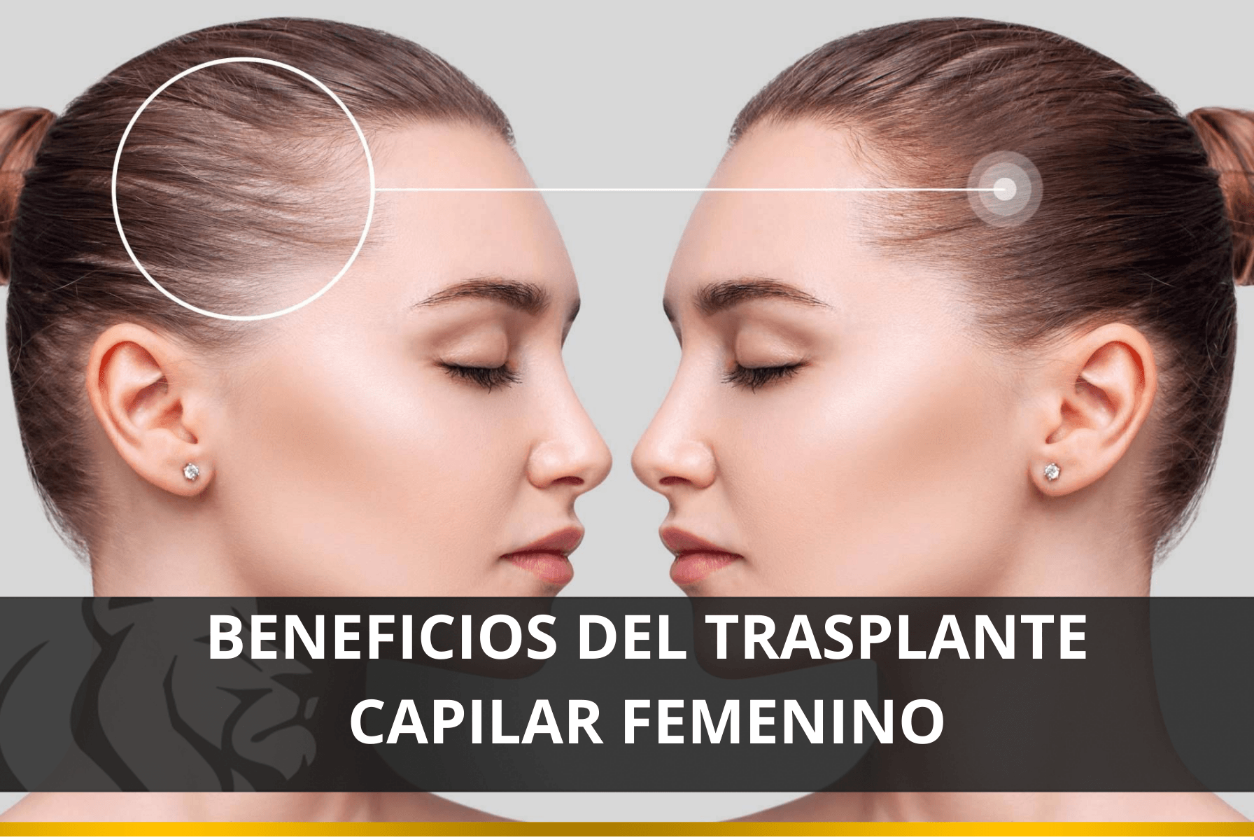 Beneficios del Trasplante Capilar Femenino