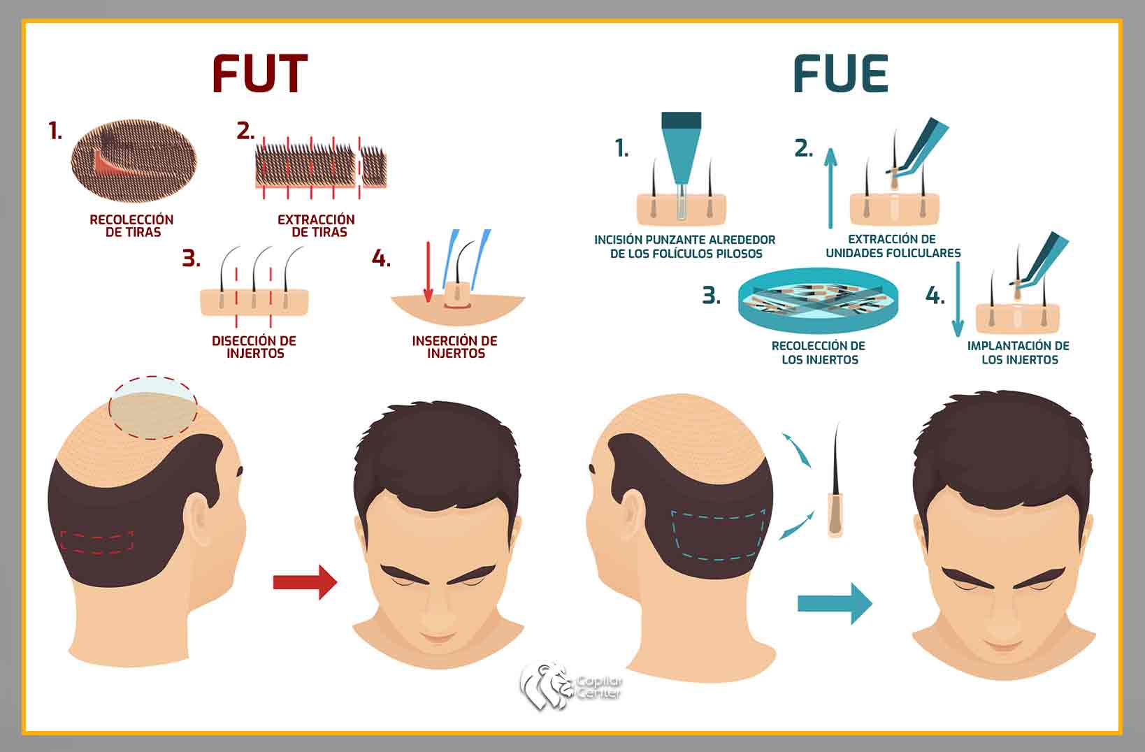 Descubre el impacto psicológico de la calvicie - Fue Fut
