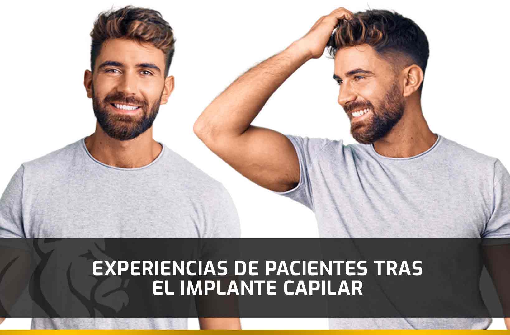 Experiencias de pacientes tras el Implante Capilar