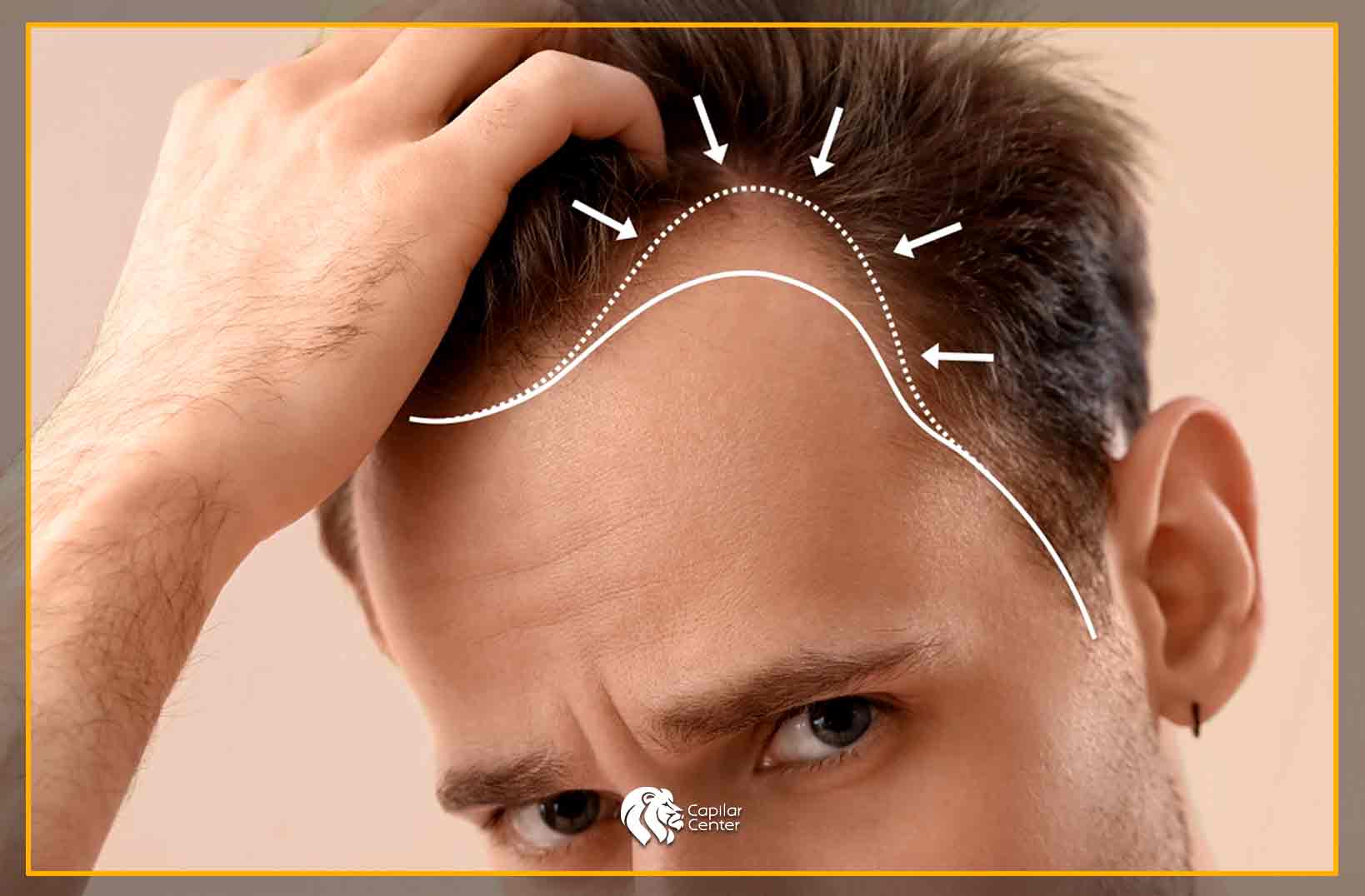 Genética y Pérdida de Cabello: Una Relación Intrincada