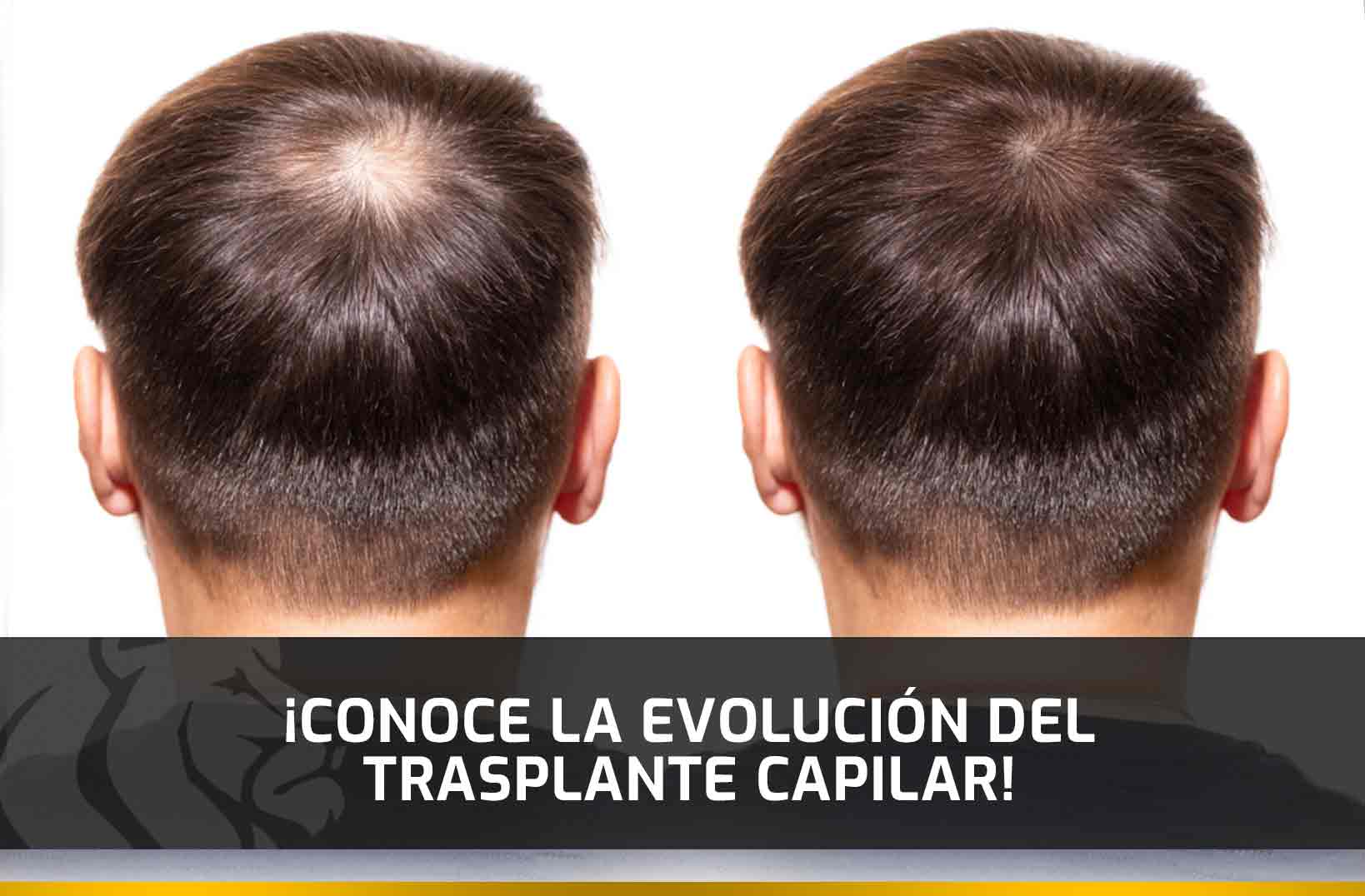 ¡Conoce la evolución del Trasplante Capilar!