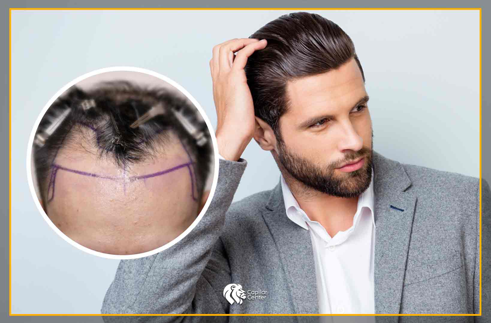 Recomendaciones para realizarte un trasplante capilar correctamente