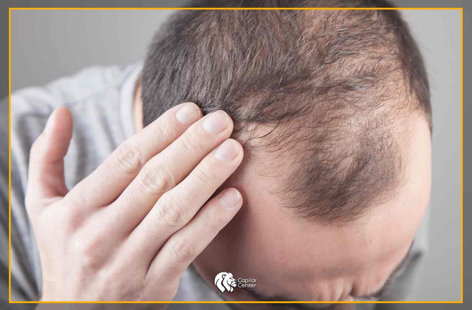 Alopecia por falta de hierro