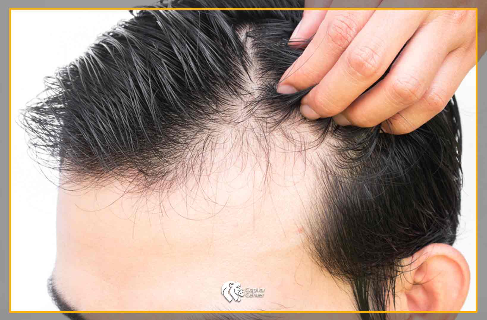 ¿Por qué se da la caída de cabello en las personas?