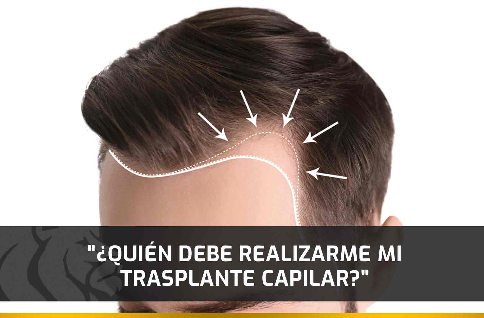 ¿Quién debe realizarme mi Trasplante Capilar?