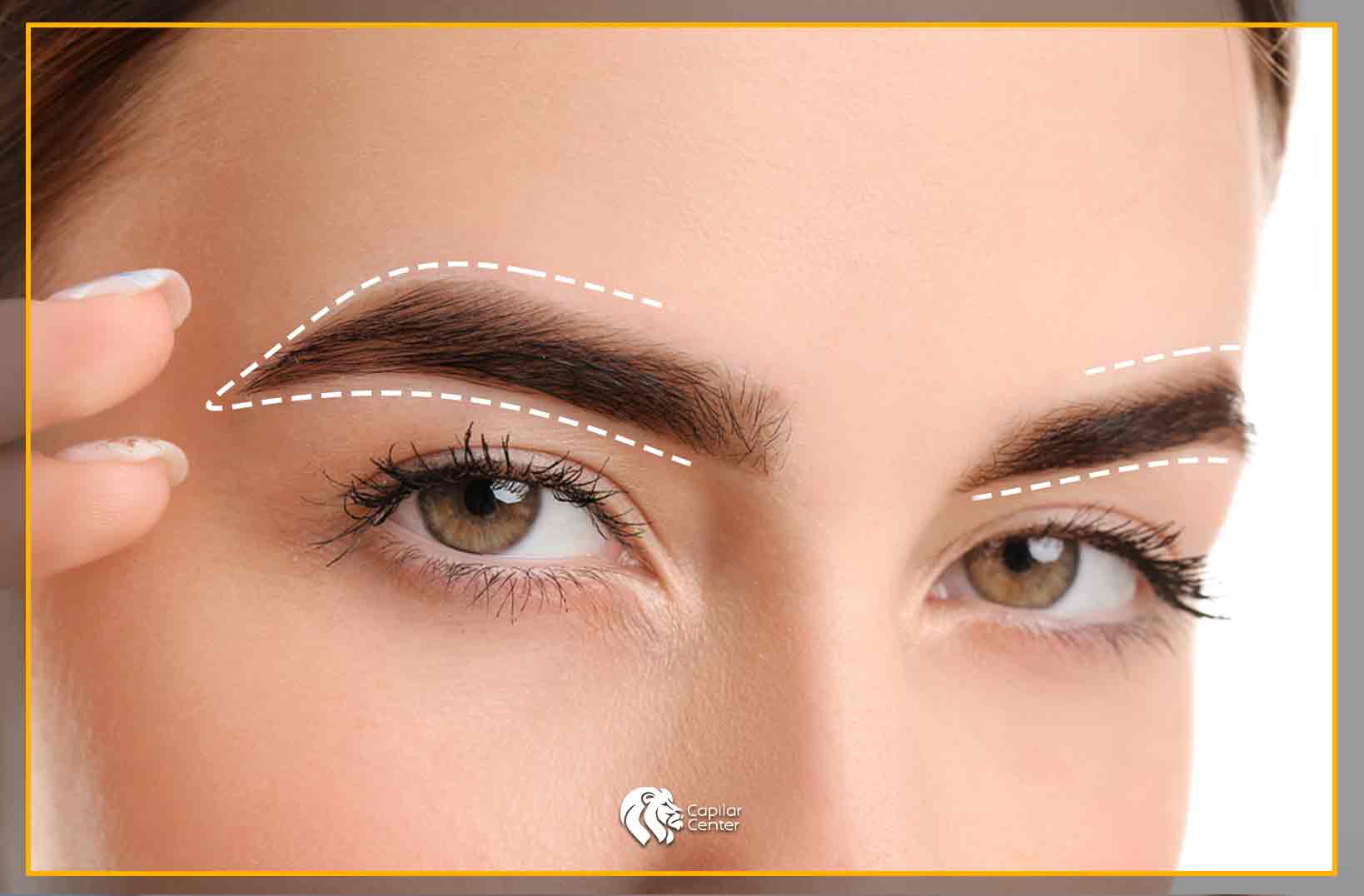 ¿Qué es el Trasplante de Cejas?