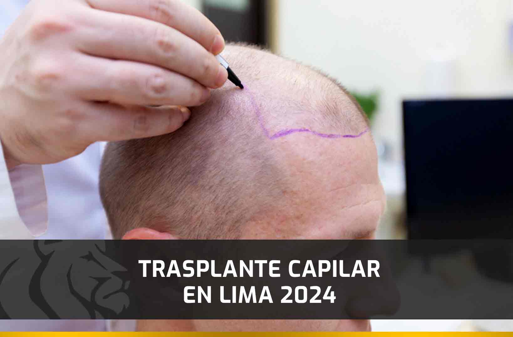 Trasplante Capilar en Lima 2024