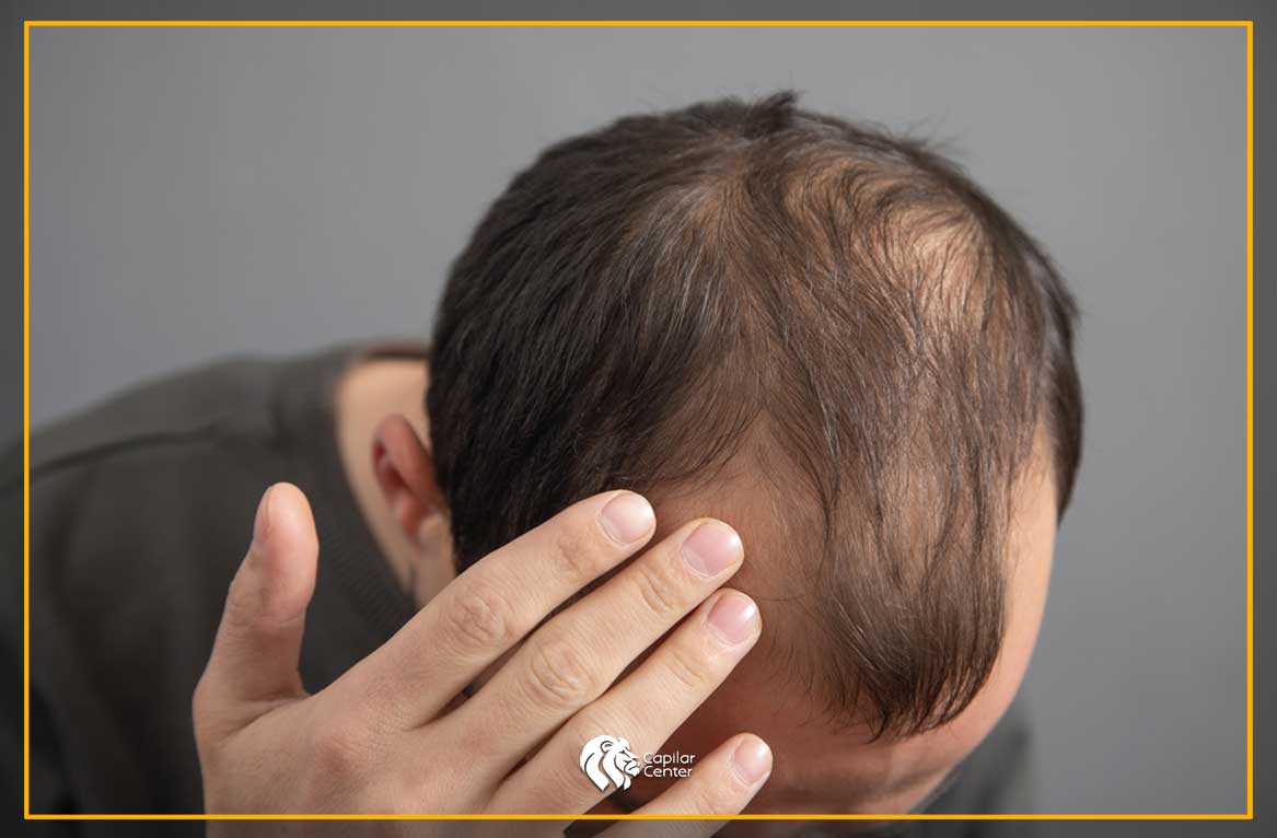 Alopecia Areata y la Genética