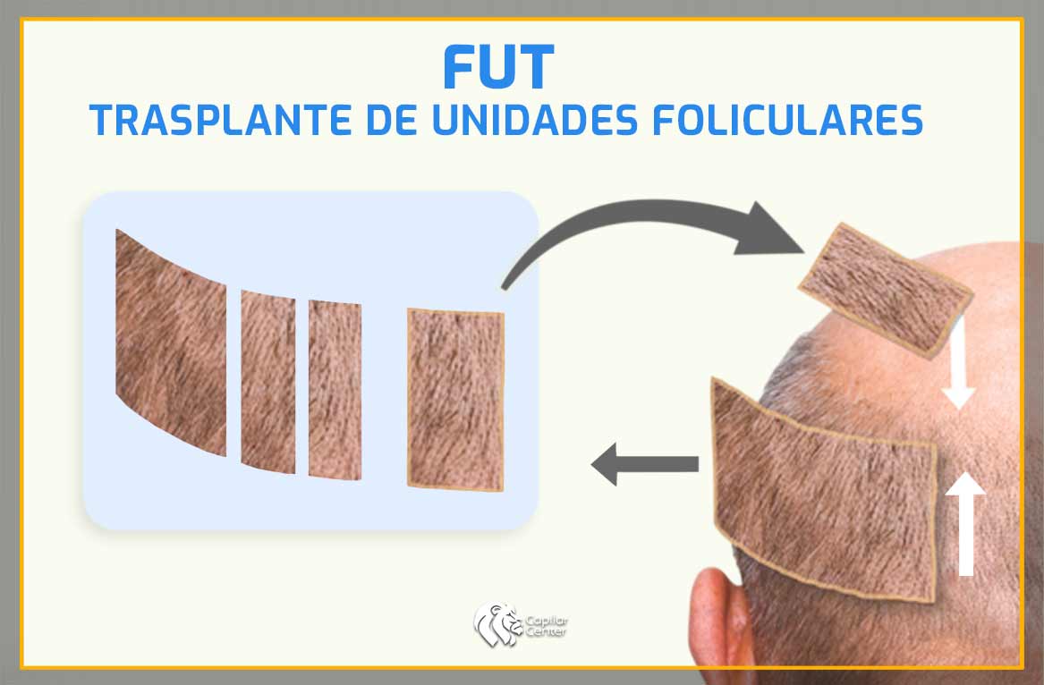 ¿Qué es la técnica FUT o FUSS?
