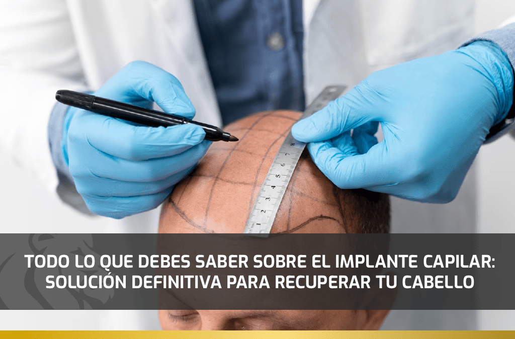 Todo lo que debes saber sobre el Implante Capilar: Solución definitiva para recuperar tu cabello