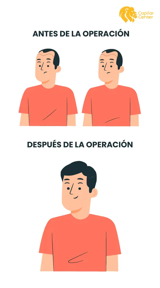 Trasplante Capilar Resultados