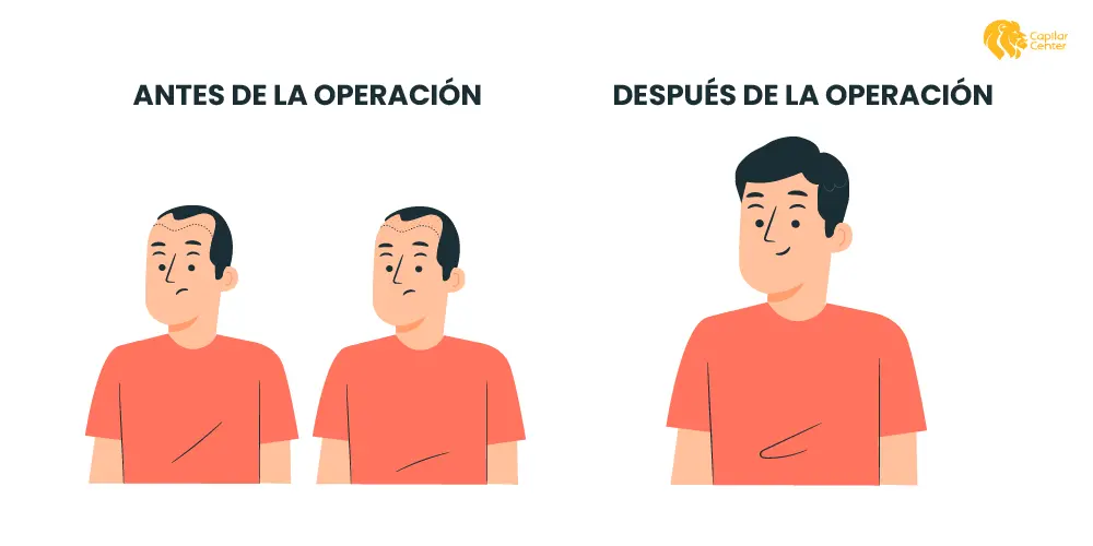 Trasplante Capilar Resultados