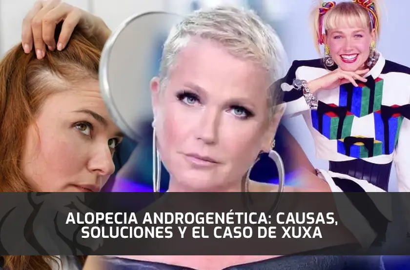 Alopecia Androgenética: Causas, Soluciones y el Caso de Xuxa