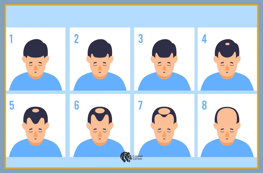 ¿Cuáles son las zonas frecuentes para dichos métodos?