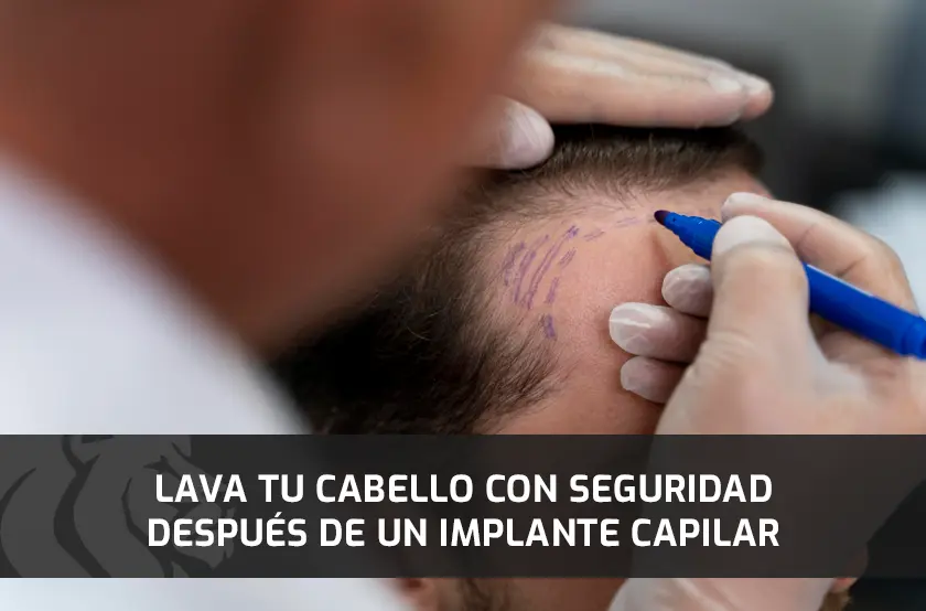 Lava tu Cabello con Seguridad Después de un Implante Capilar