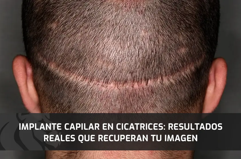 Implante Capilar en Cicatrices: Resultados Reales que Recuperan tu Imagen