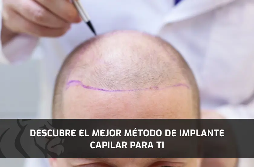 Descubre el Mejor Método de Implante Capilar para Ti