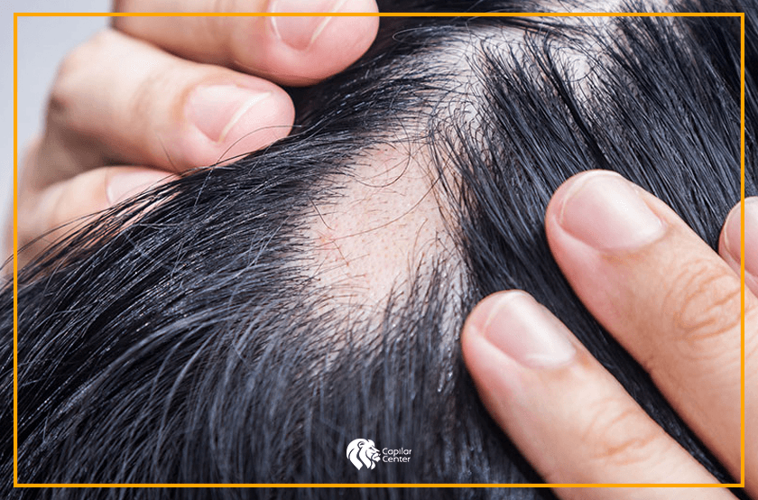 ¿Es normal que se caiga el cabello?