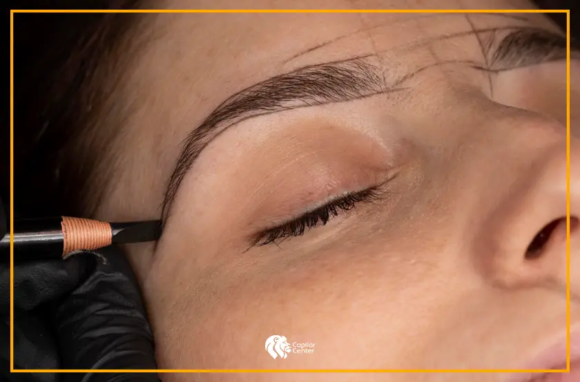 ¿Qué es el trasplante de cejas?