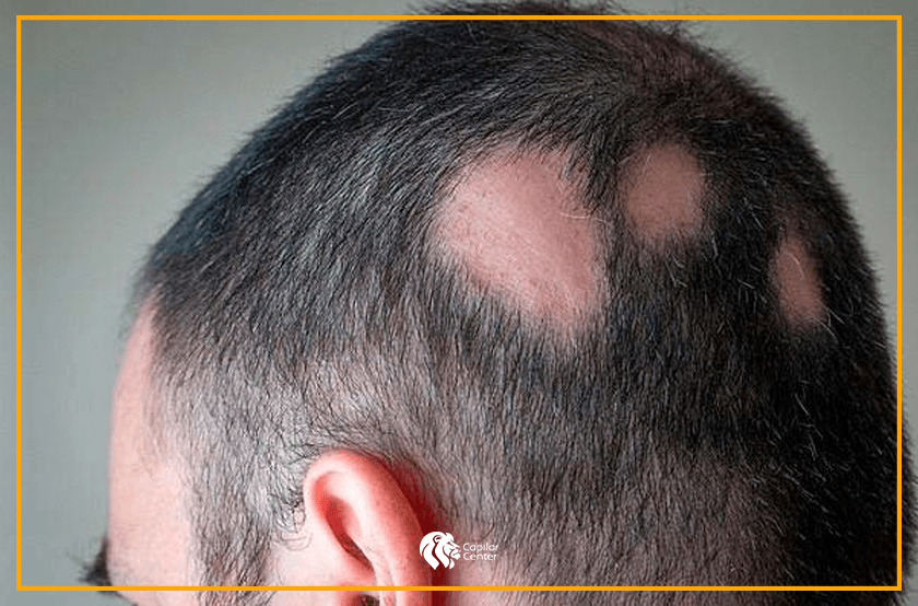 Soluciones médicas y estéticas para la caída del cabello