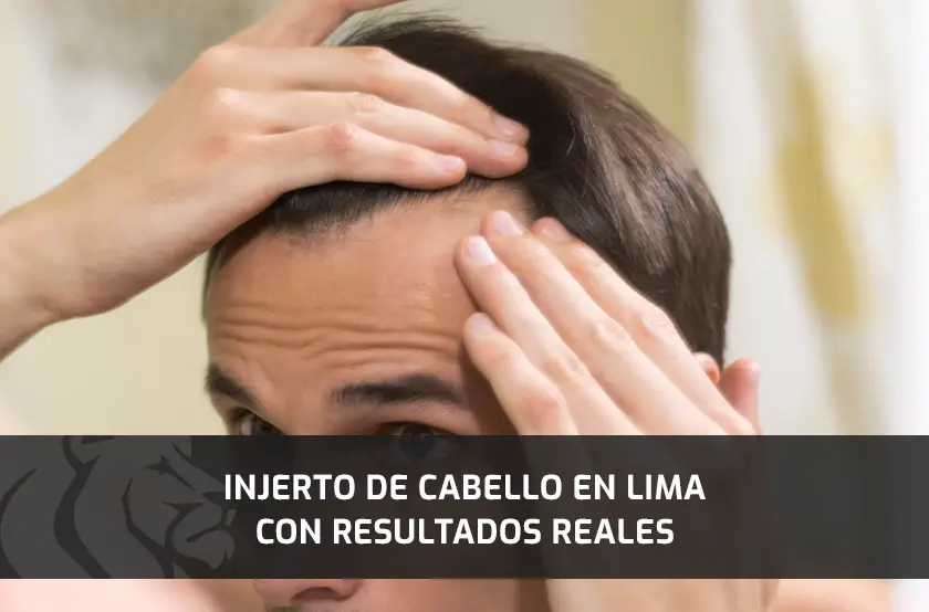 Injerto de Cabello en Lima con Resultados Reales