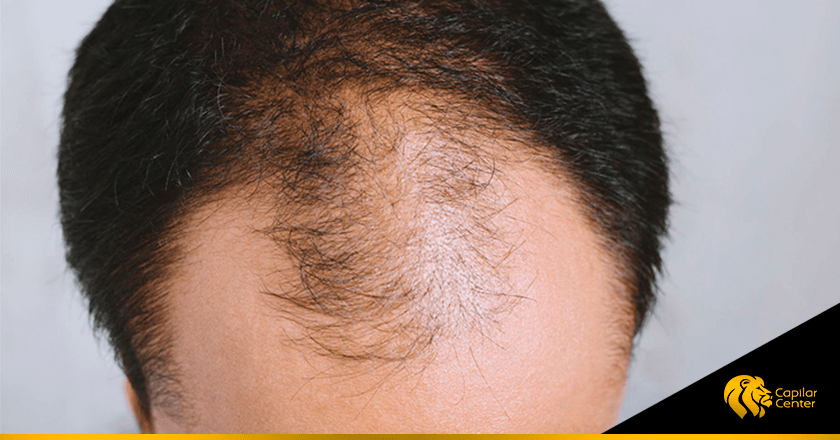 ¿Cuál es la mejor clínica en alopecia masculina?
